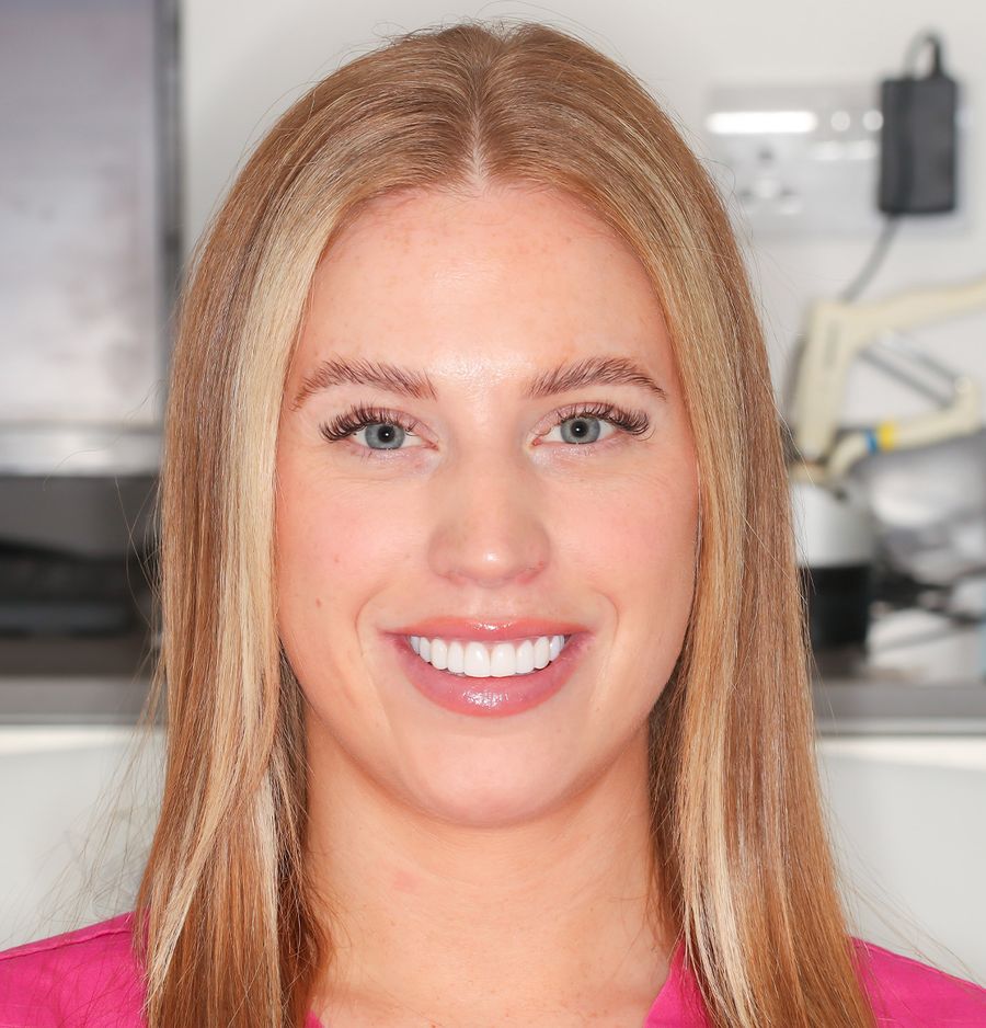 Composite Bonding  - Shannen Heffernan After